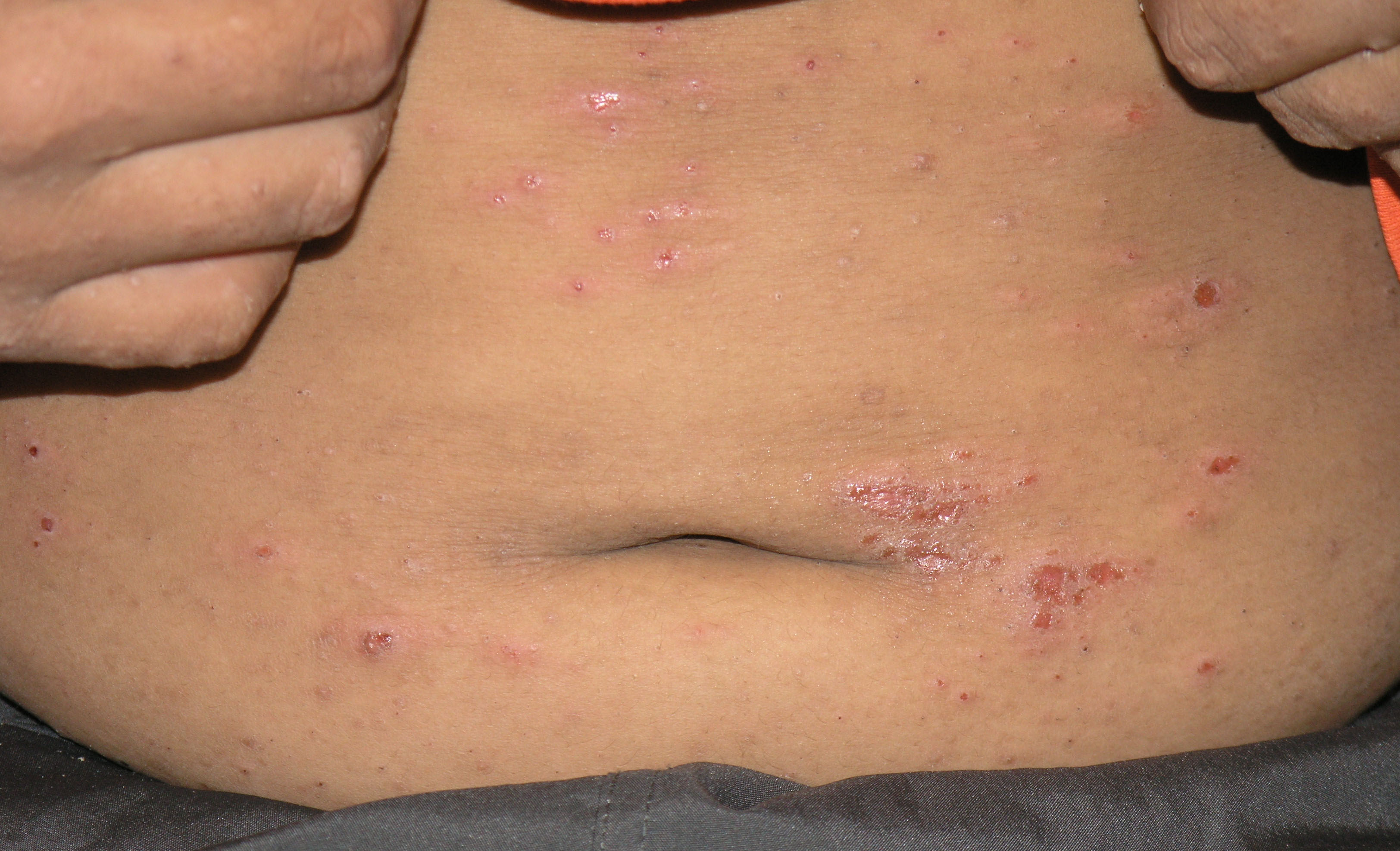 scabies bites pictures